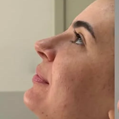 Antes: perfil com queixo pouco definido