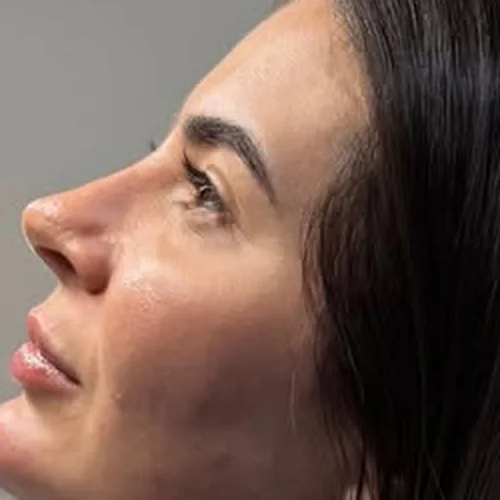 Depois da perfiloplastia
