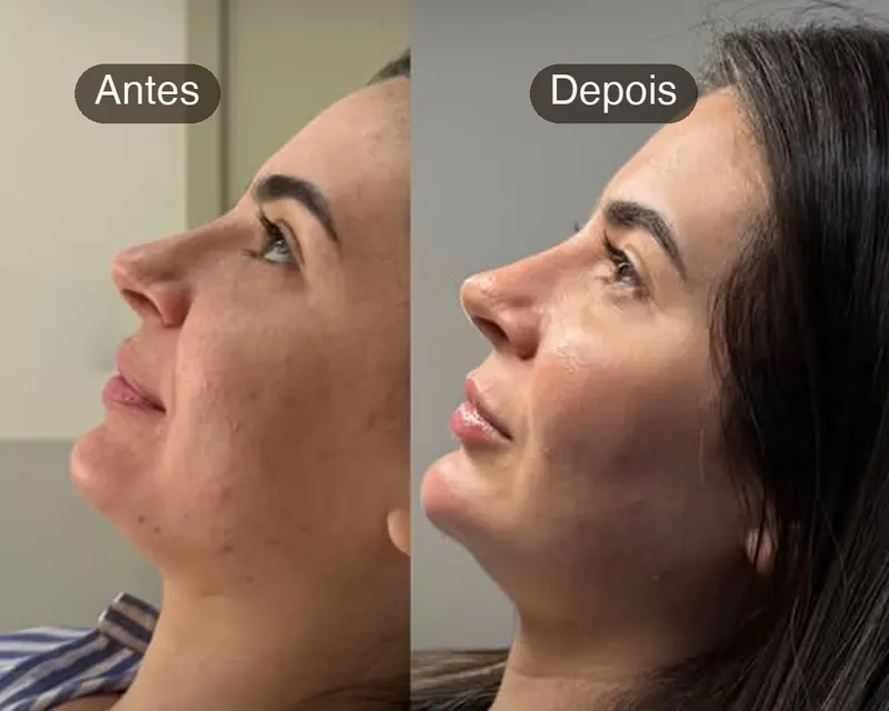 Perfil de paciente antes e depois da perfiloplastia