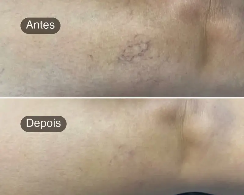 Pele da perna antes e depois do tratamento de vasinhos